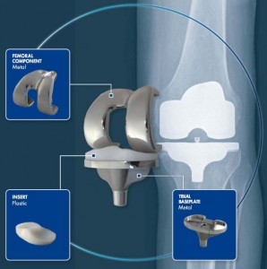 knee-replacement1